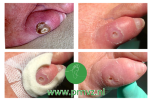behandeling diabetische voet